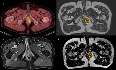 Case Report: Adaptive radiotherapy in the radiation salvage of prostate cancer